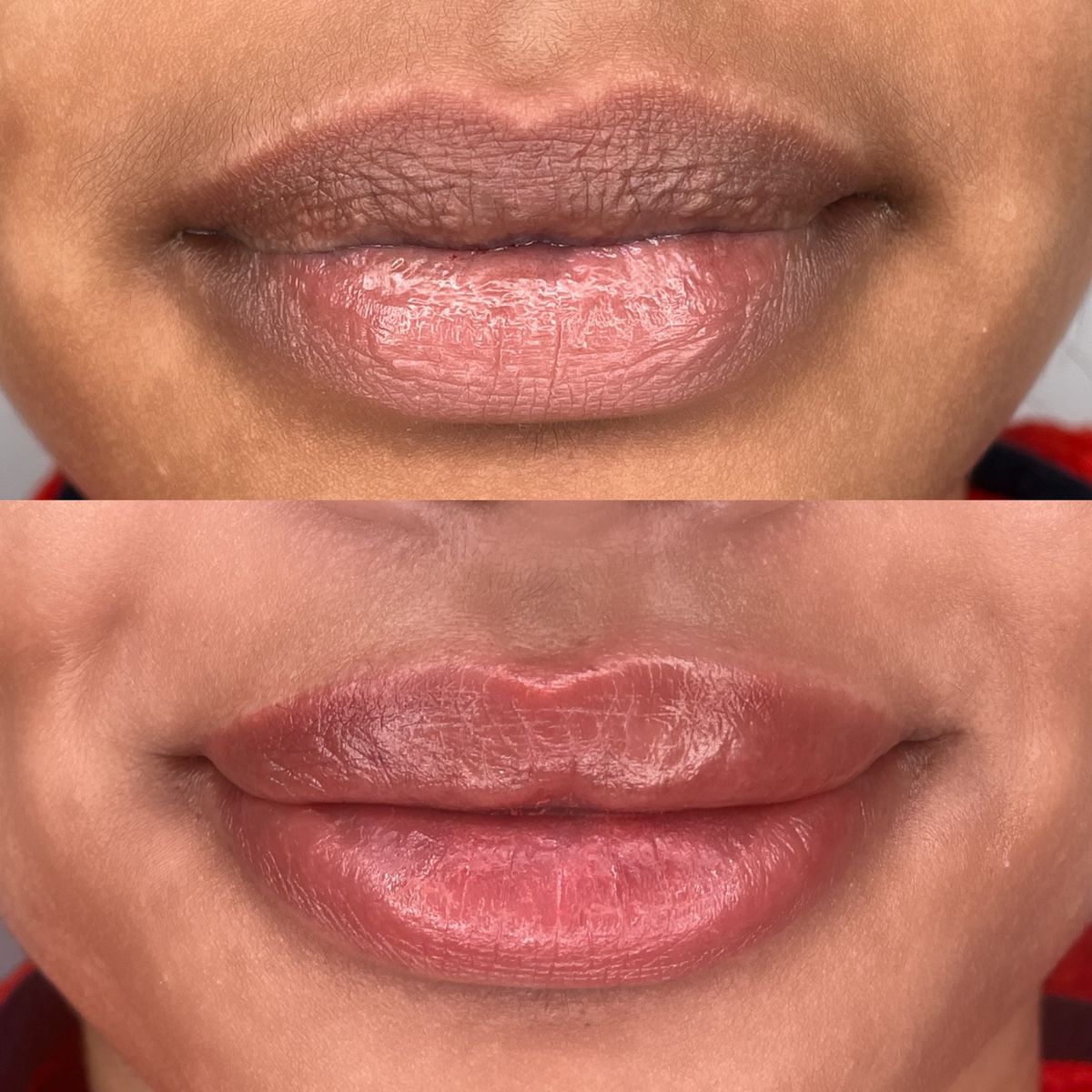 Dark Lip Neutralization