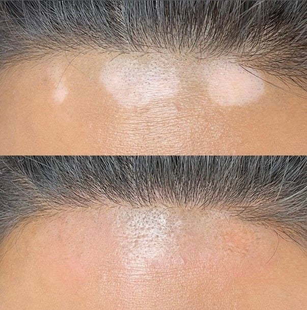 Vitiligo Camouflage