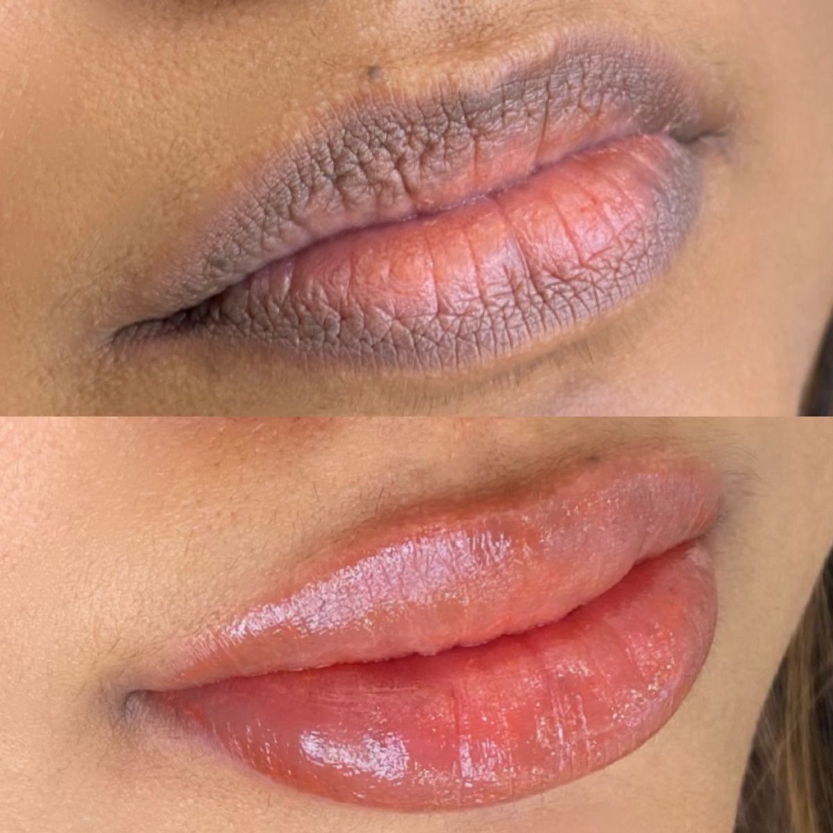 Lips Touch-Up (6-12 Weeks)